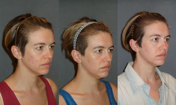 The writer before Fractora, after one treatment and after two treatments. Photo: Courtesy of Megan McIntyre/Dr. Min Ahn