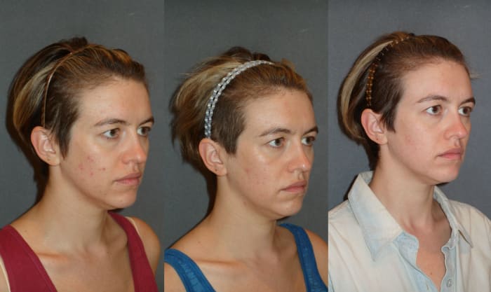 The writer before Fractora, after one treatment and after two treatments. Photo: Courtesy of Megan McIntyre/Dr. Min Ahn